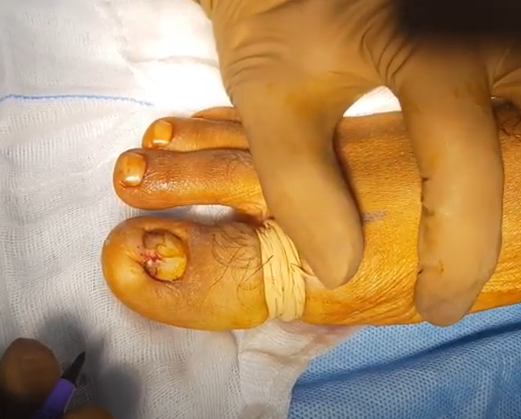 best diabetic foot surgeon in chennai