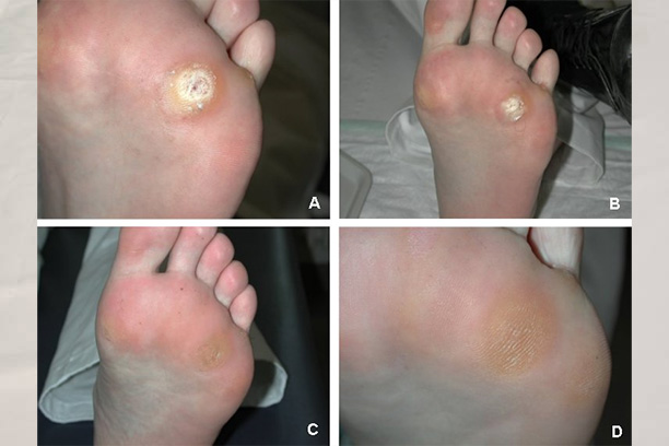 Chennai foot wound care